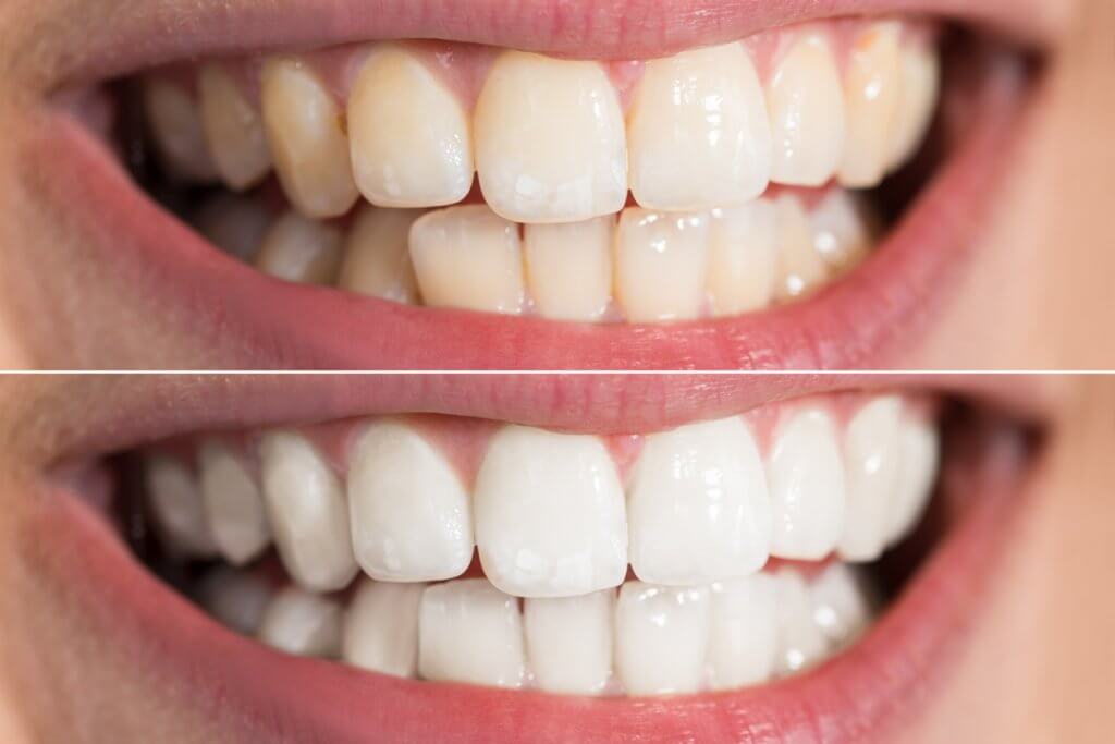 Teeth showing before and after teeth whitening process
