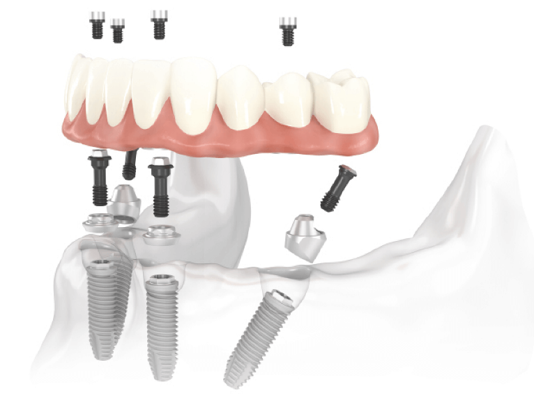 Dental implants