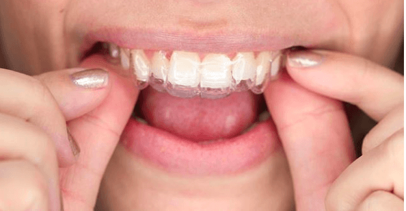 DIY clear aligners