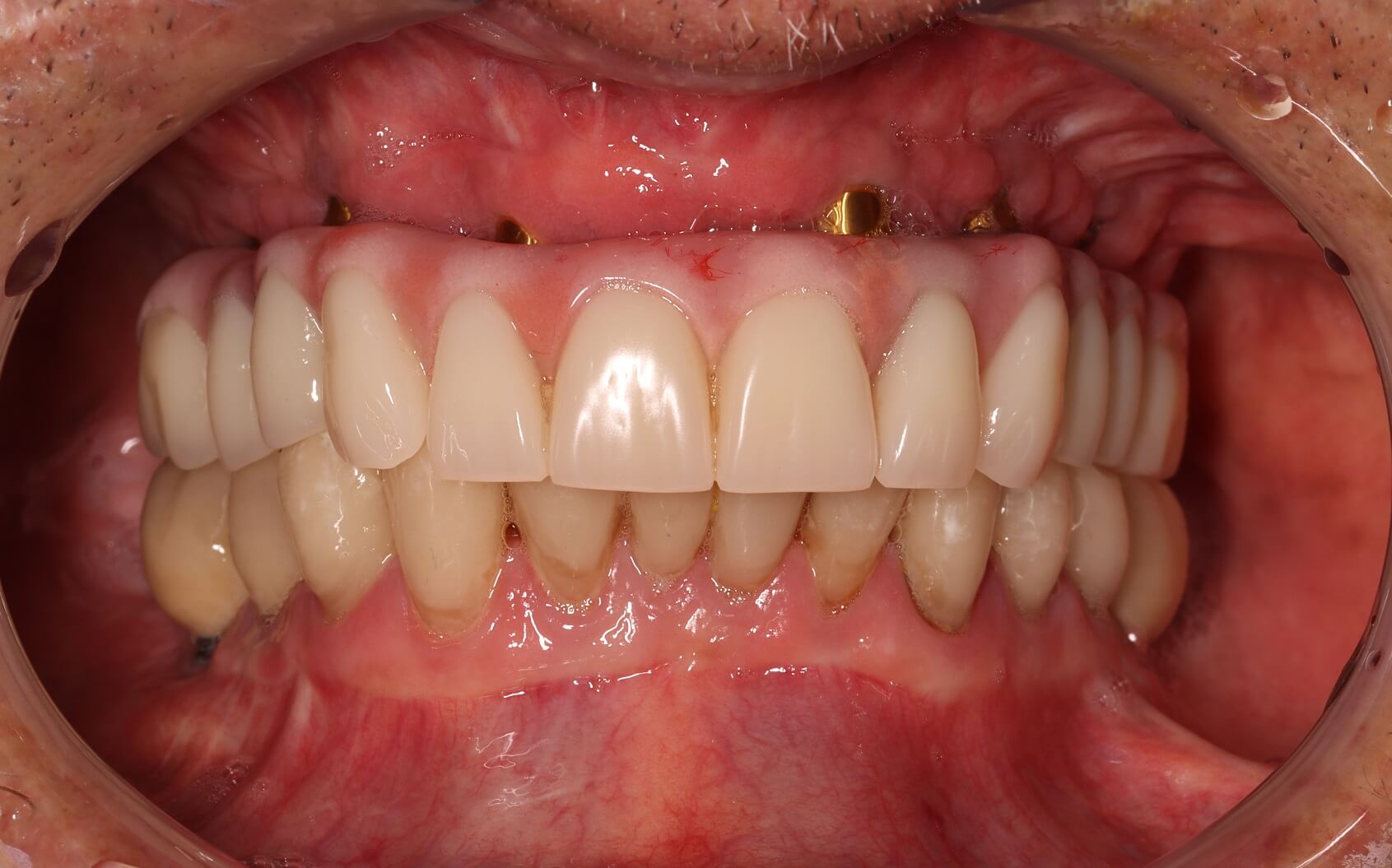 dental implants patients story: full mouth restoration