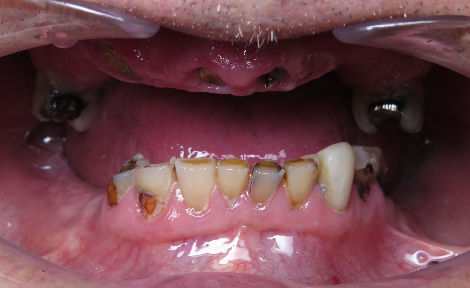 dental implants patients story