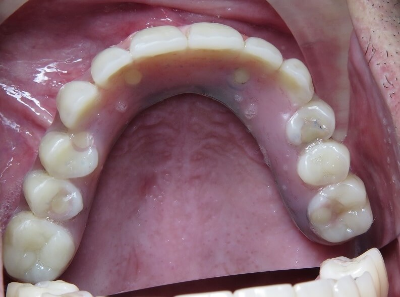 dental implants patients story, upper arch dental implants