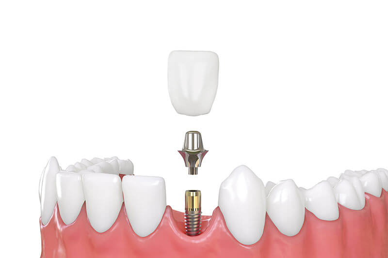 Dental implants versus bridges, single dental implant