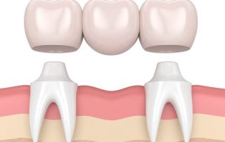 Dental implants versus bridges, dental bridge