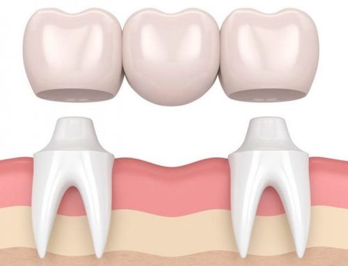 Dental Implants Versus Bridges