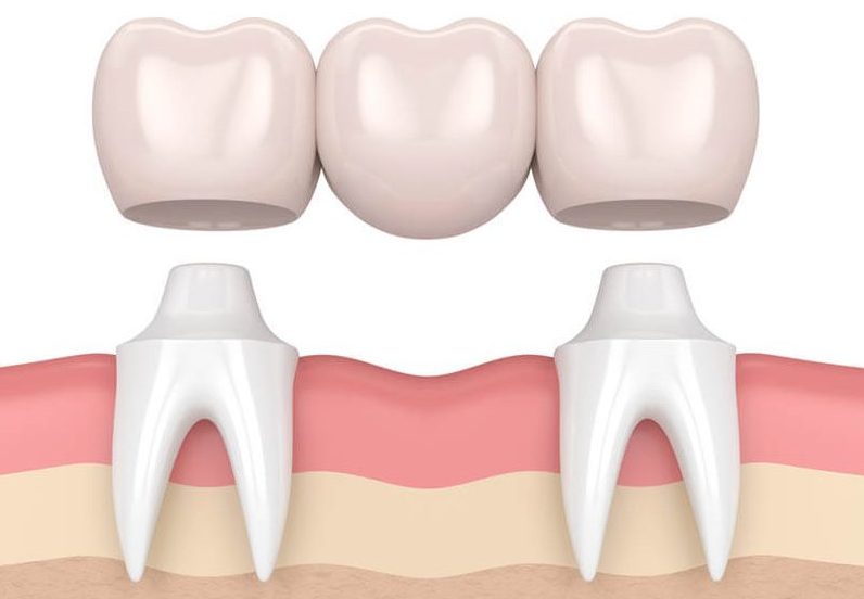 Implants vs bridges pic 2 Dental implants versus bridges, dental bridge