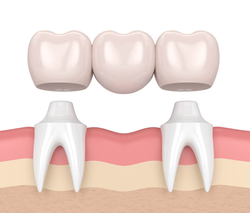 Dental implants versus bridges, dental bridge
