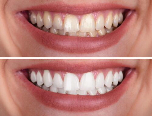 How Long Does Teeth Whitening Last?