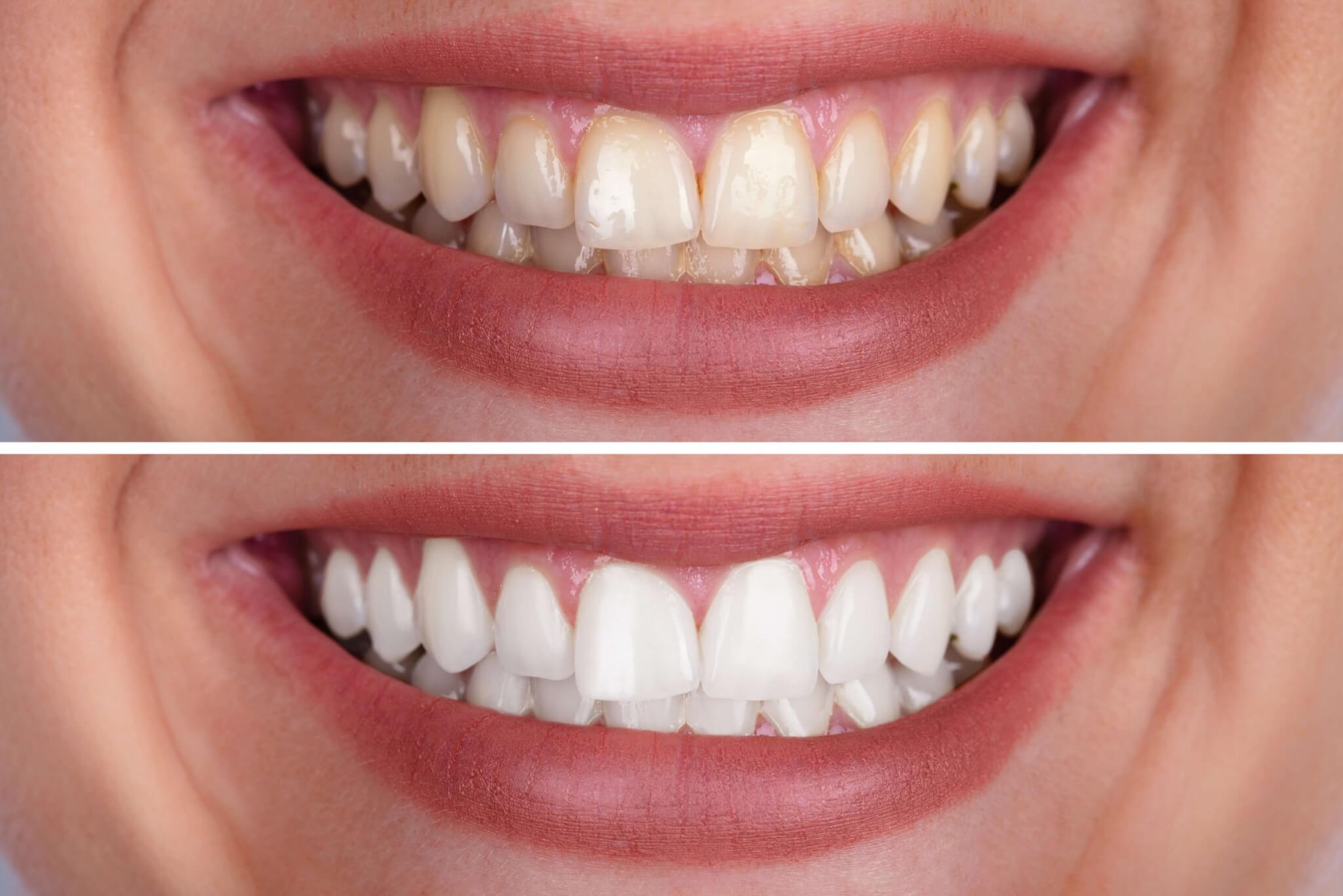 how-long-does-teeth-whitening-last-pic-scaled.jpeg