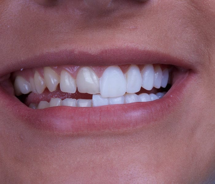 teeth veneers auckland