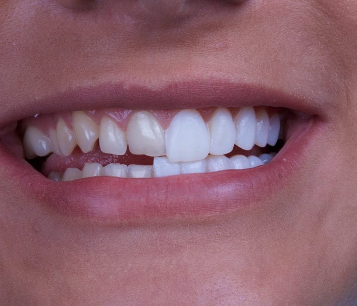 Veneers before and after teeth veneers auckland