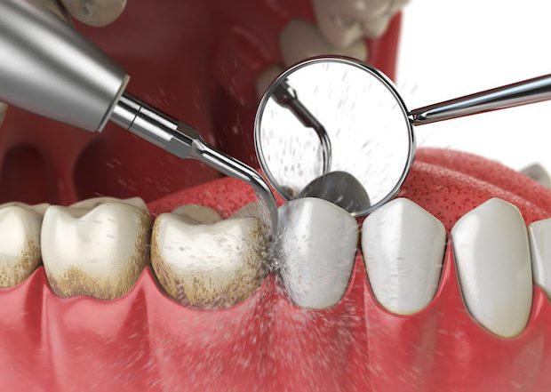 When should you get your teeth professionally cleaned, professional teeth cleaning, oral hygiene