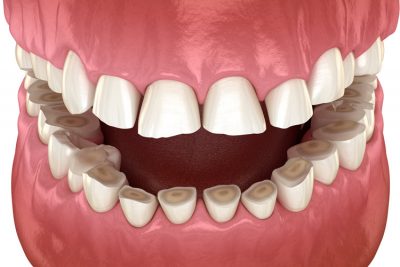 bruxism treatment