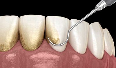 gum disease