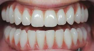 Dental implants after 2