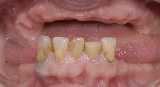Dental implants before 2 Before dental implants, cost of dental implants