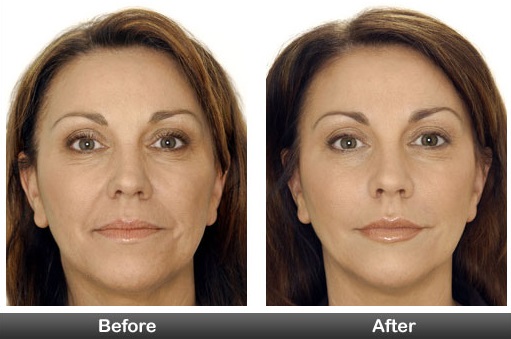 What to expect at your Botox appointment, Botox before and after