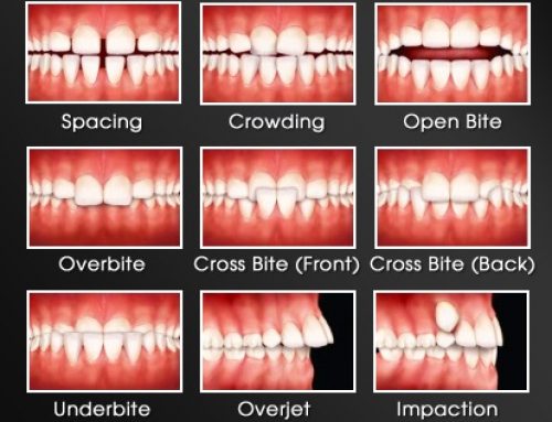 Can clear aligners fix an overbite? - SmilePath NZ