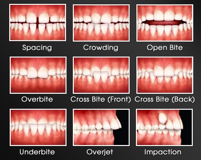 when to get an orthodontic consult, signs of orthodontic problems, teeth alignment problems, examples of crooked teeth