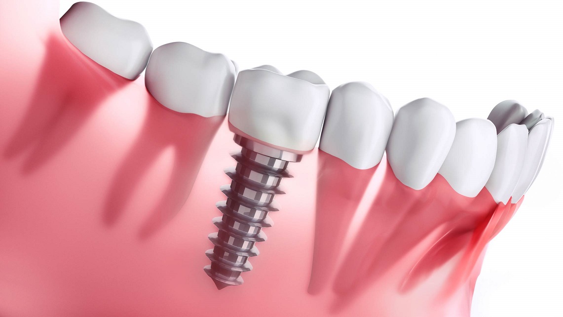 tooth replacement options, dental implant