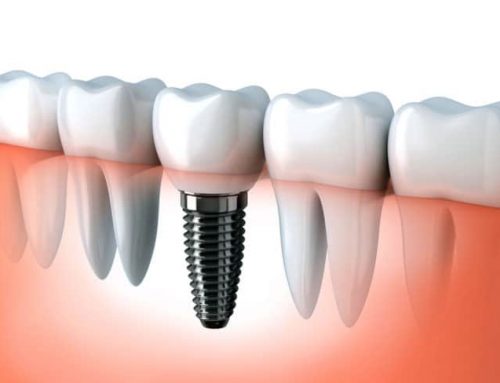 How Long Do Dental Implants Last?