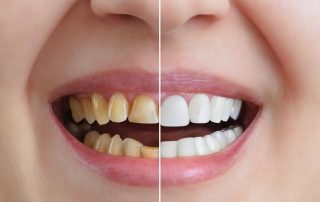 smile makeover, cosmetic dentistry