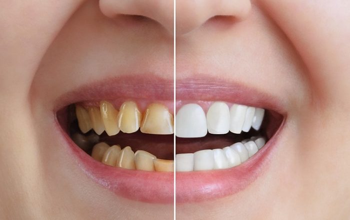 smile makeover, cosmetic dentistry