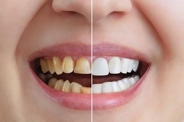 smile makeover, cosmetic dentistry