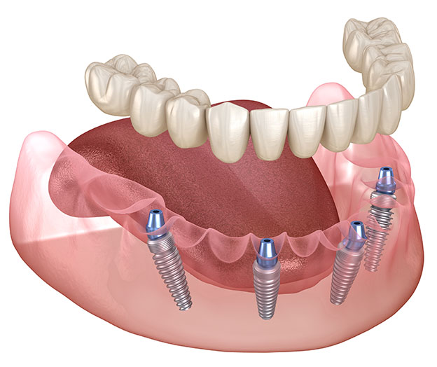 all on 4 dental implants