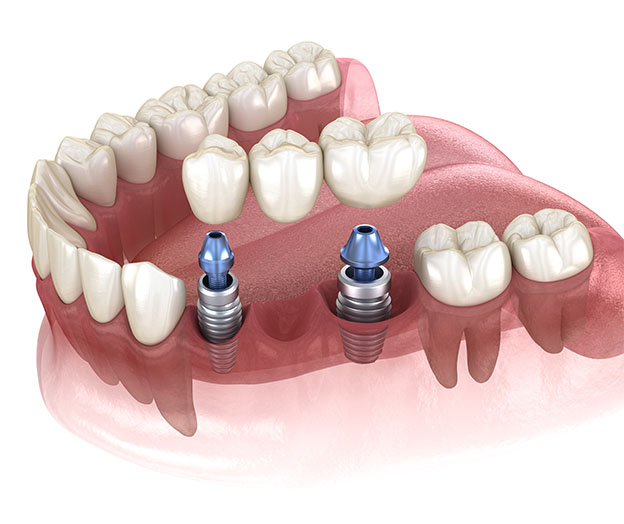 dental implant bridge