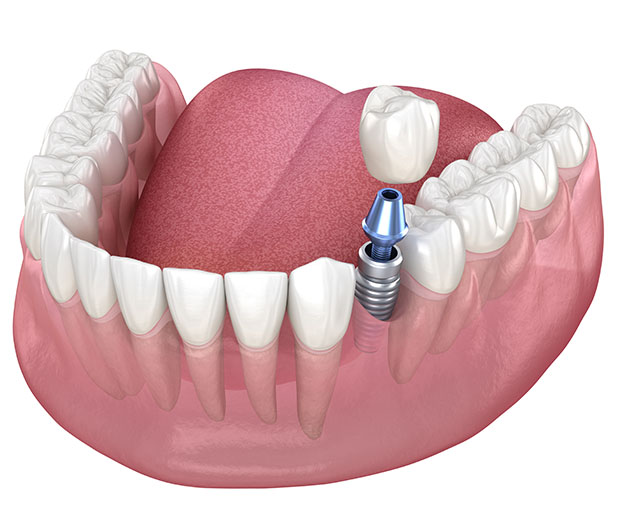 dental implant crown