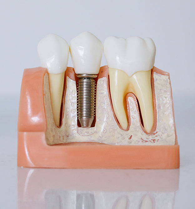 auckland dental implants